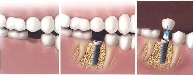 مراحل ایمپلنت و کاشت دندانی