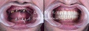 بازسازی کامل دهان با ایمپلنت دکتر امیر یاری
