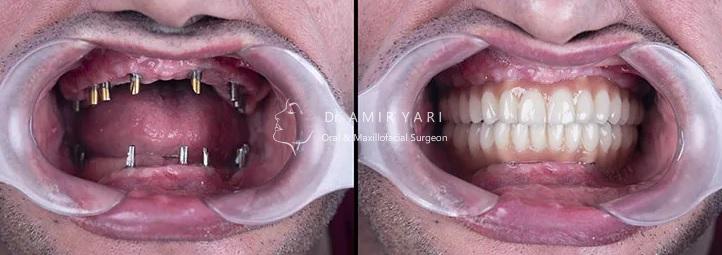 بازسازی کامل دهان با ایمپلنت دکتر امیر یاری