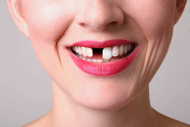 ایمپلنت دندان کاشت دندان