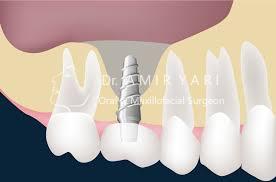 جراحی سینوس لیفت کاشت دندان