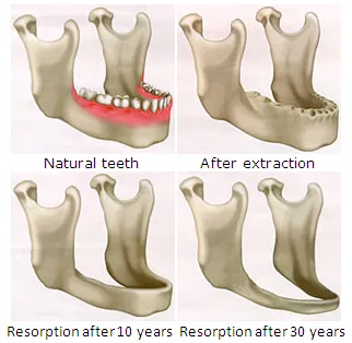 تحلیل استخوان فک بعد کشیدن دندان