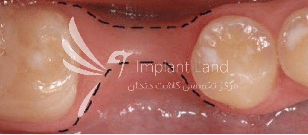 ایمپلنت چند سال بعد کشیدن دندان امکان پذیر است و ممکن است به پیوند استخوان نیاز باشد