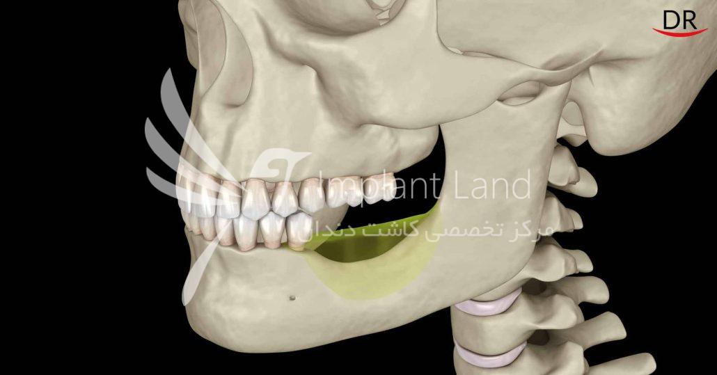 تحلیل استخوان چند سال بعد کشیدن دندان