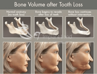 تحلیل استخوان و ایمپلنت چند سال بعد کشیدن دندان ها
