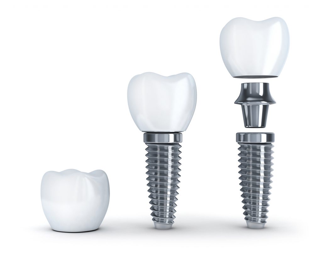 Implant 2 1024x819 1