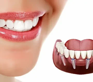 مراقبت‌های بعد از ایمپلنت دندان