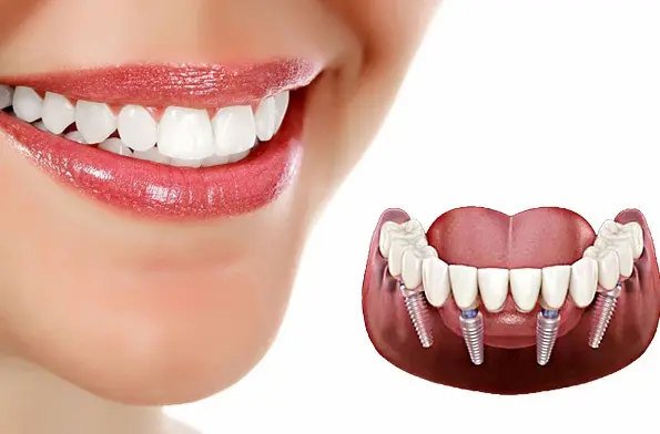 مراقبت‌های بعد از ایمپلنت دندان